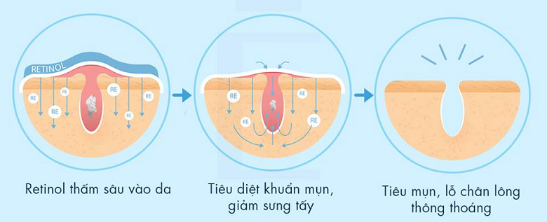 tri-mun-bang-sua-rua-mat-chua-retinol