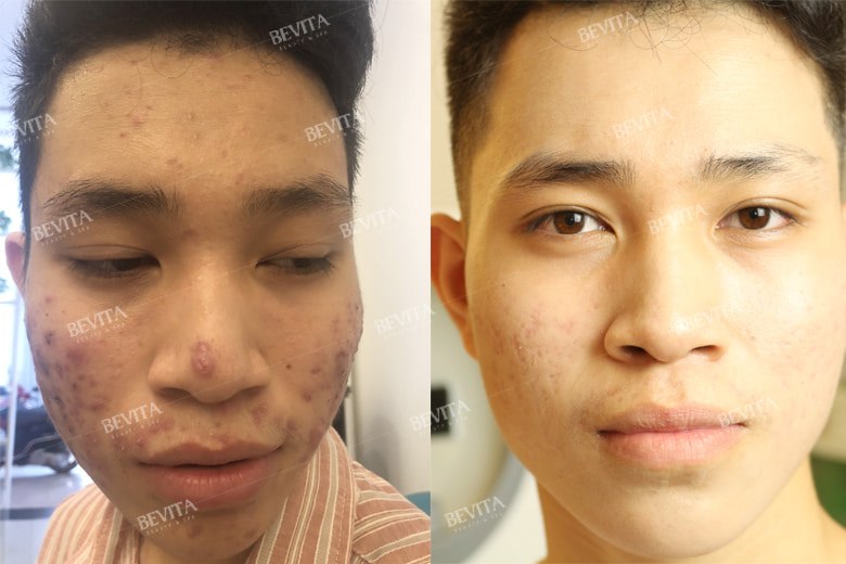 Hình ảnh trước và sau khi Khoa điều trị mụn sau 3 tháng tại Bevita