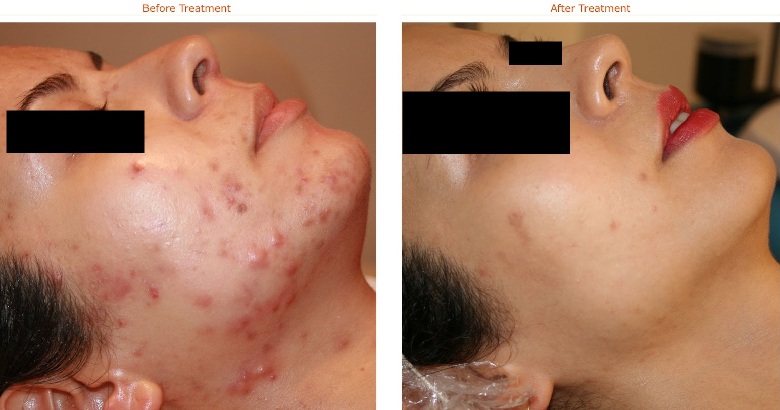 Trước và sau khi peel da